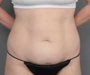 before tummy tuck female patient front view case 4482