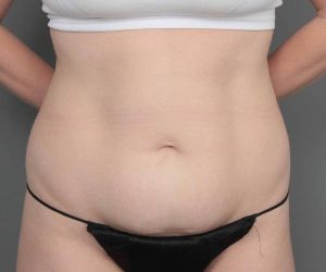 before tummy tuck female patient front view case 4482