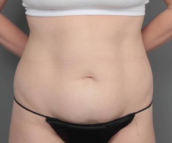 before tummy tuck female patient front view case 4482