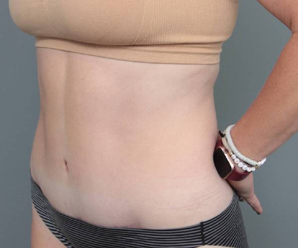 after tummy tuck female patient left angle view case 4482