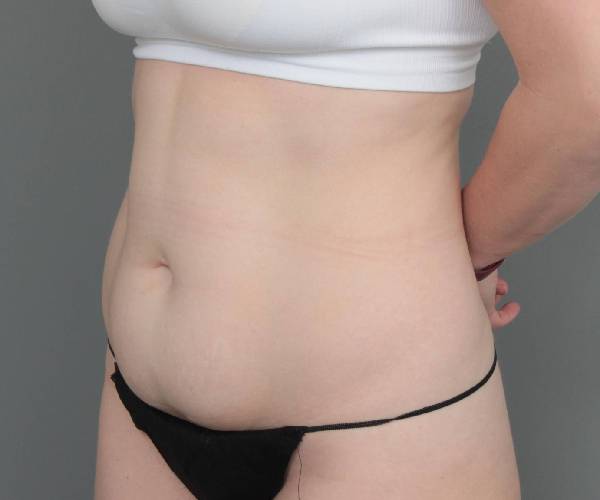 before tummy tuck female patient left angle view case 4482