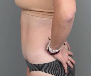 after tummy tuck female patient left side view case 4482