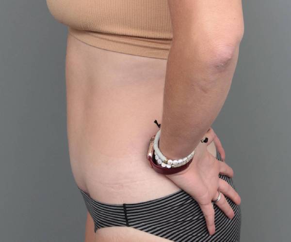 after tummy tuck female patient left side view case 4482