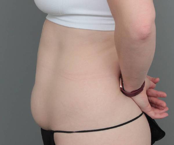 before tummy tuck female patient left side view case 4482