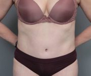 after tummy tuck female patient front view case 4489