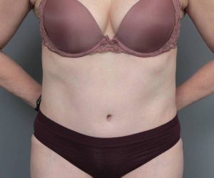 after tummy tuck female patient front view case 4489