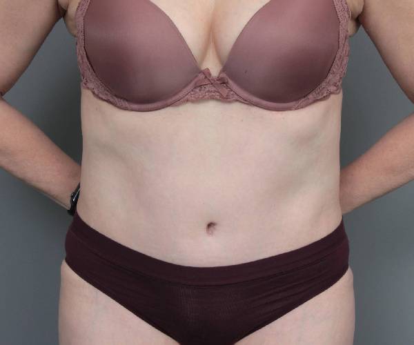 after tummy tuck female patient front view case 4489