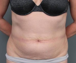 before tummy tuck female patient front view case 4489