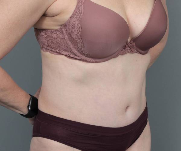after tummy tuck female patient right angle view case 4489