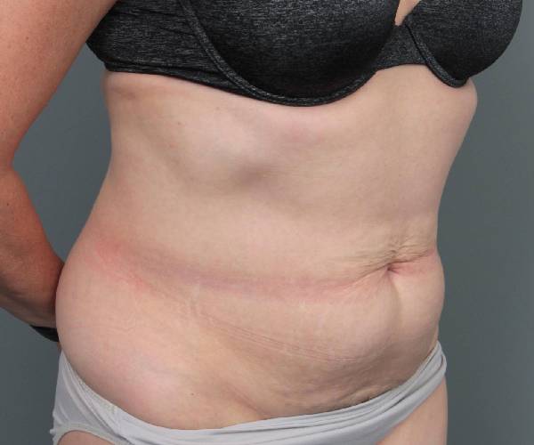 before tummy tuck female patient right angle view case 4489