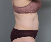 after tummy tuck female patient right side view case 4489