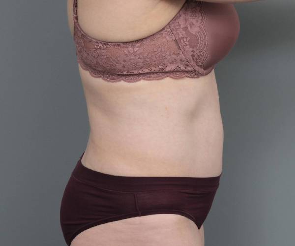 after tummy tuck female patient right side view case 4489