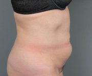 before tummy tuck female patient right side view case 4489