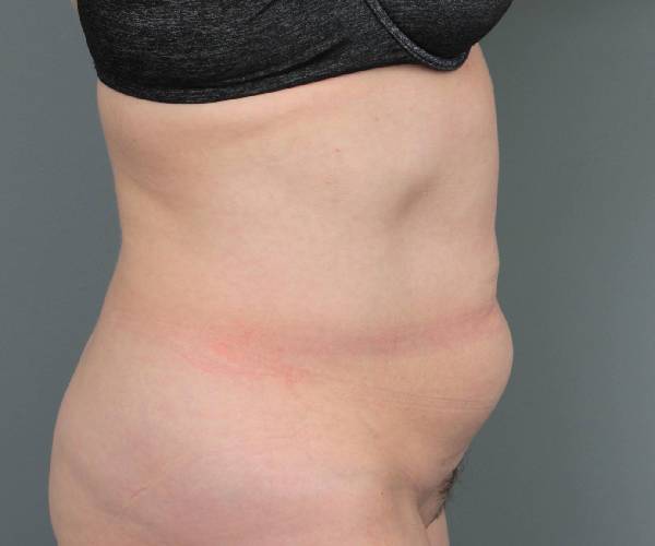 before tummy tuck female patient right side view case 4489