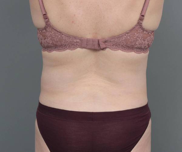 after tummy tuck female patient back view case 4489