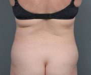before tummy tuck female patient back view case 4489