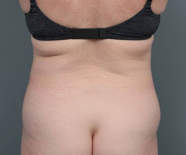 before tummy tuck female patient back view case 4489