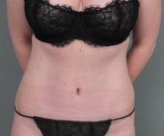 after tummy tuck female patient front view case 4498