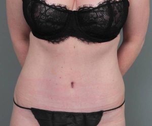 after tummy tuck female patient front view case 4498