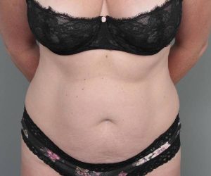 before tummy tuck female patient front view case 4498