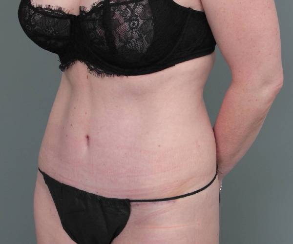 after tummy tuck female patient left angle view case 4498