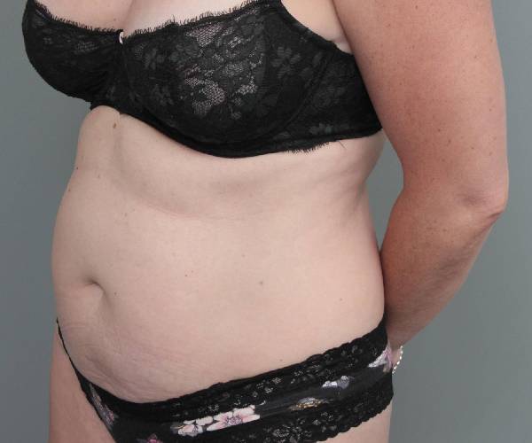 before tummy tuck female patient left angle view case 4498