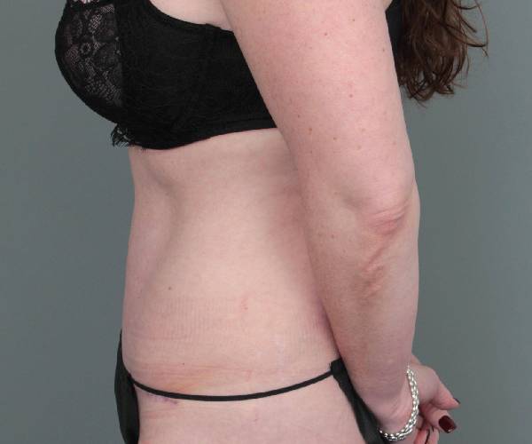 after tummy tuck female patient left side view case 4498