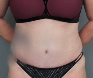 after tummy tuck female patient front view case 4505