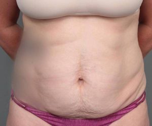 before tummy tuck female patient front view case 4505
