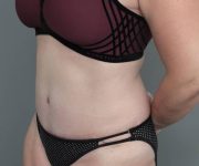 after tummy tuck female patient left angle view case 4505