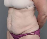 before tummy tuck female patient left angle view case 4505