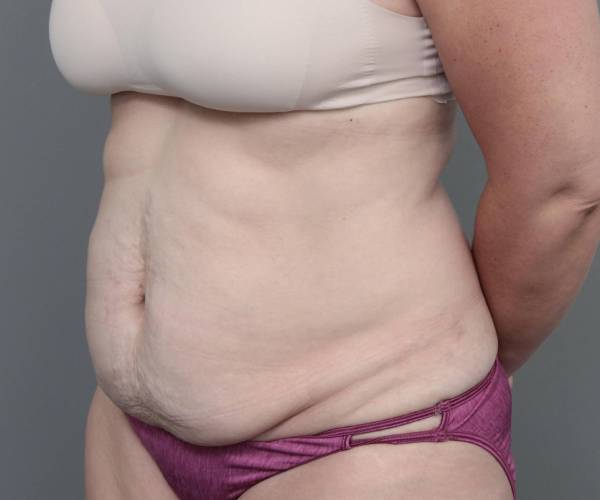 before tummy tuck female patient left angle view case 4505