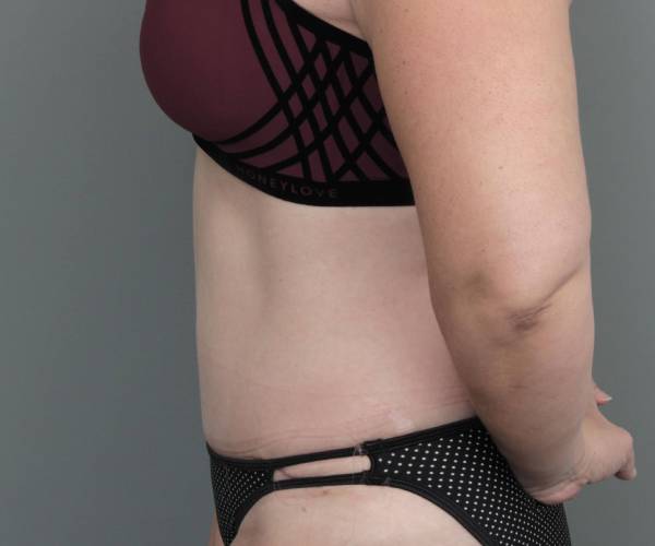 after tummy tuck female patient left side view case 4505