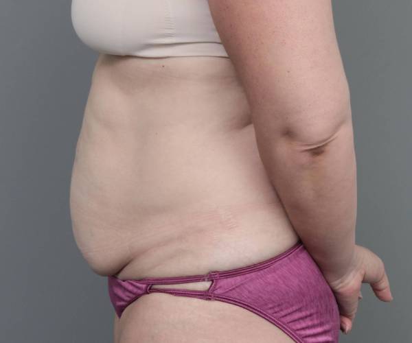 before tummy tuck female patient left side view case 4505