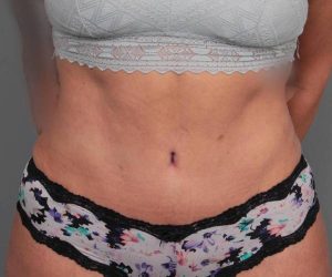 after tummy tuck female patient front view case 4512
