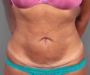 before tummy tuck female patient front view case 4512