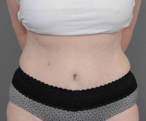 after tummy tuck female patient front view case 4517
