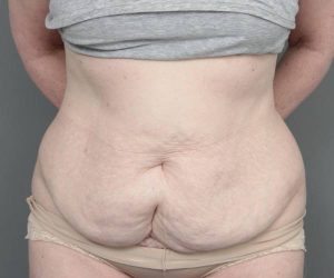 before tummy tuck female patient front view case 4517