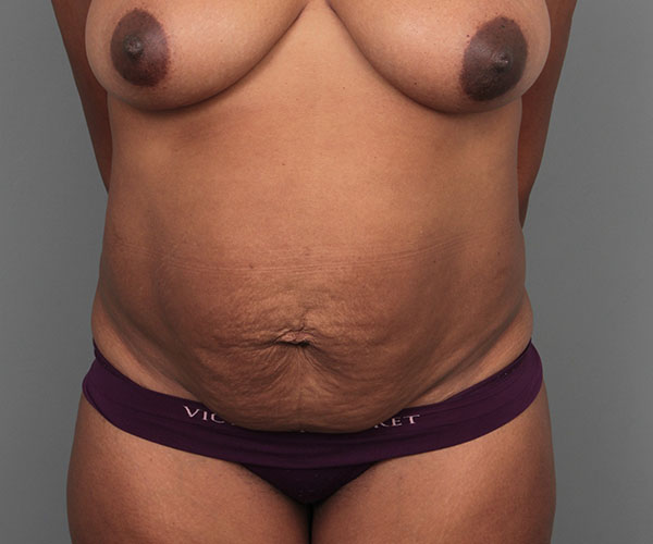 before tummy tuck front view of female patient 4461