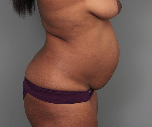 before tummy tuck rear right side view of female patient 4461