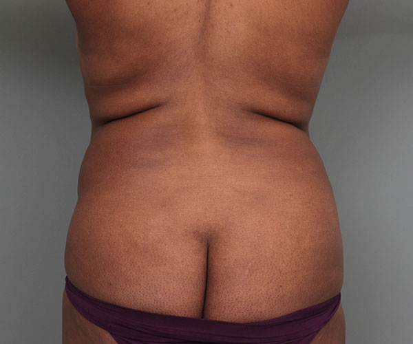 after tummy tuck rear rear view of female patient 4461
