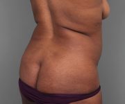 after tummy tuck rear right angle view of female patient 4461