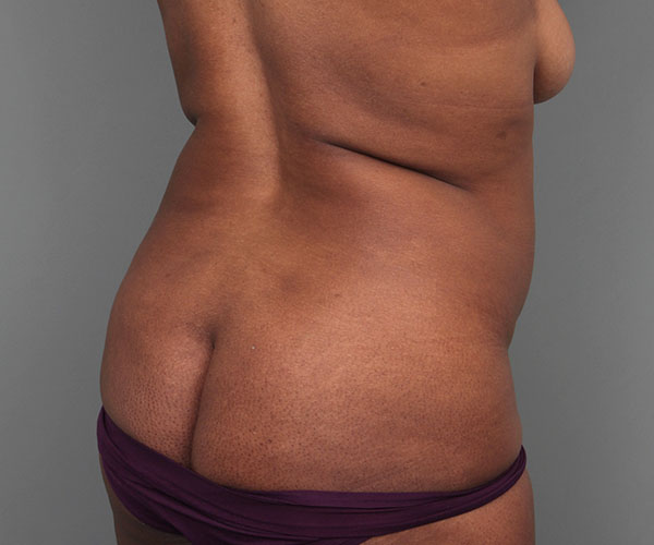 after tummy tuck rear right angle view of female patient 4461