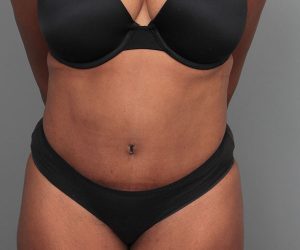 before tummy tuck front view of female patient 4461
