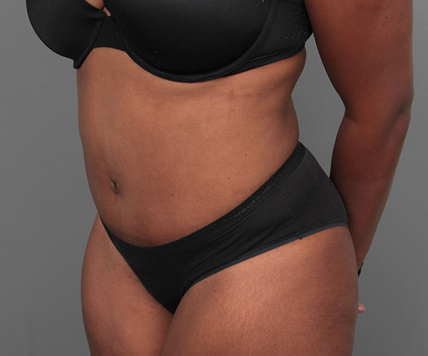 after tummy tuck rear left angle view of female patient 4461