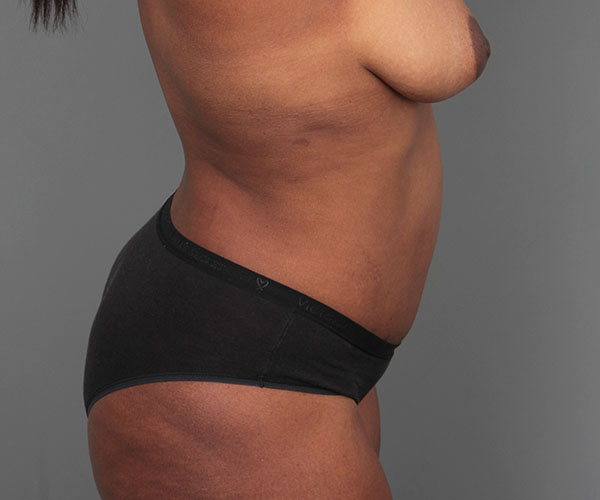 after tummy tuck right side view of female patient 4461