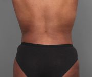 after tummy tuck rear view of female patient 4461