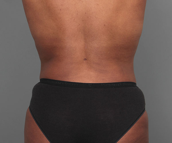 after tummy tuck rear view of female patient 4461