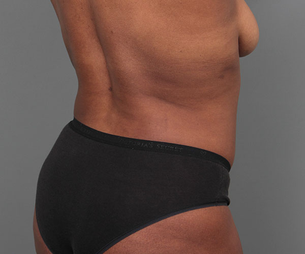 after tummy tuck rear right angle view of female patient 4461
