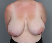 before breast reduction front view of female patient 6097